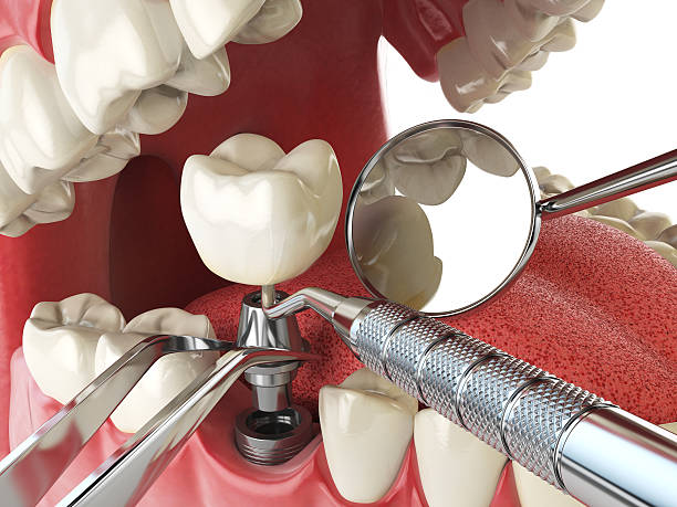 Best Urgent Care for Lost Fillings or Crowns in Union, MO